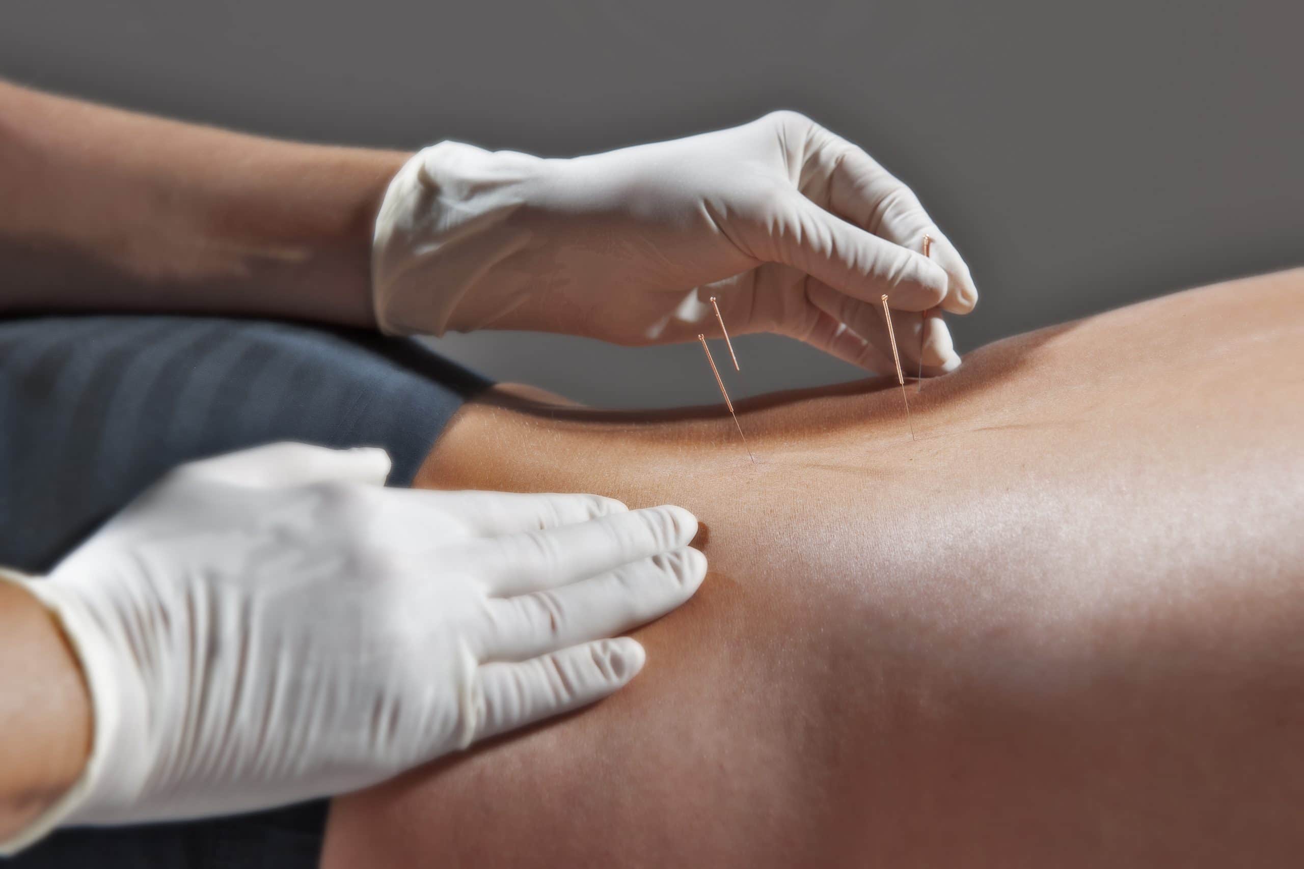 Tussen traditie en moderniteit: acupunctuur als middel tot genezing